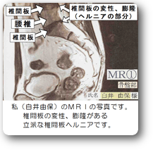 ヘルニアの画像 ヘルニアの画像